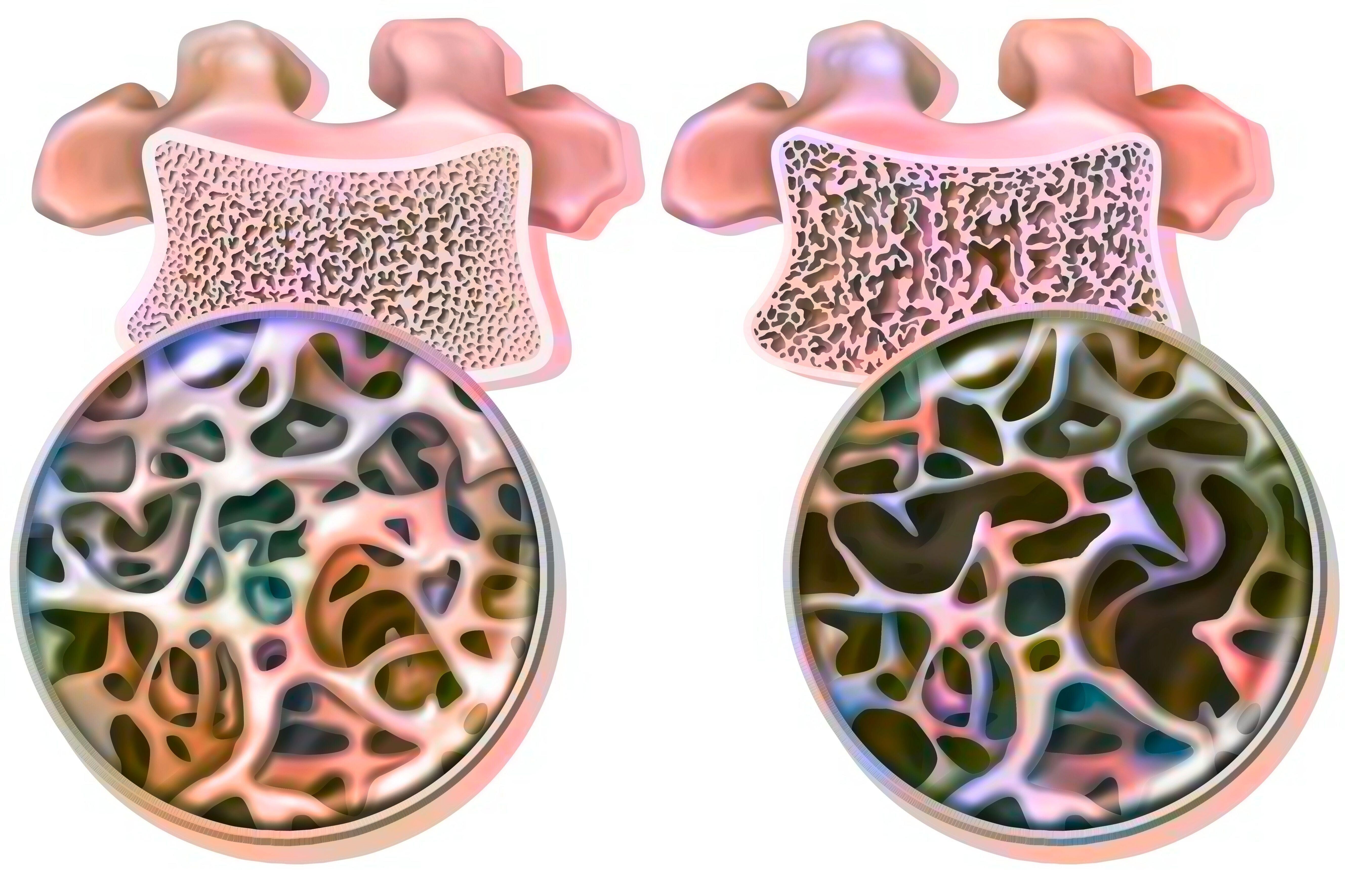 Campaign cover image for 2025 Iowa Bone Club Sponsorship Donation Drive